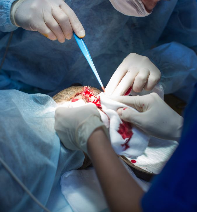 Stapler Circumcision (1)